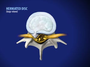 herniated disc