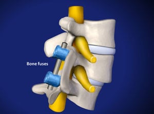 spinalfusion_300